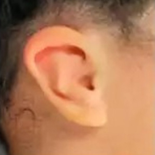 microtia-grade-1
