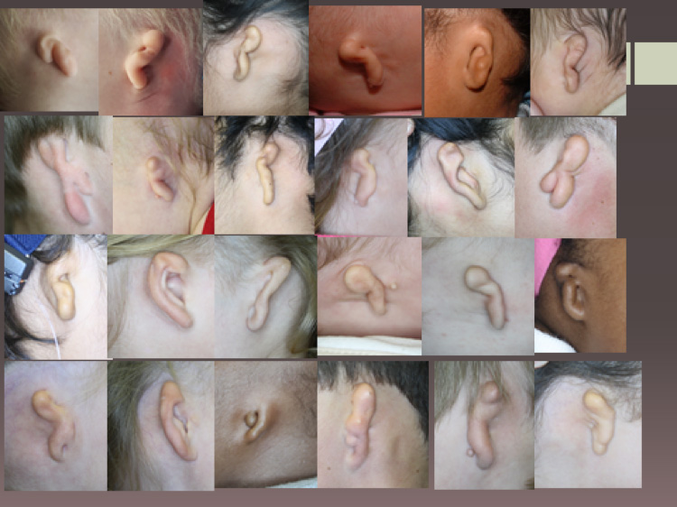 microtia-images
